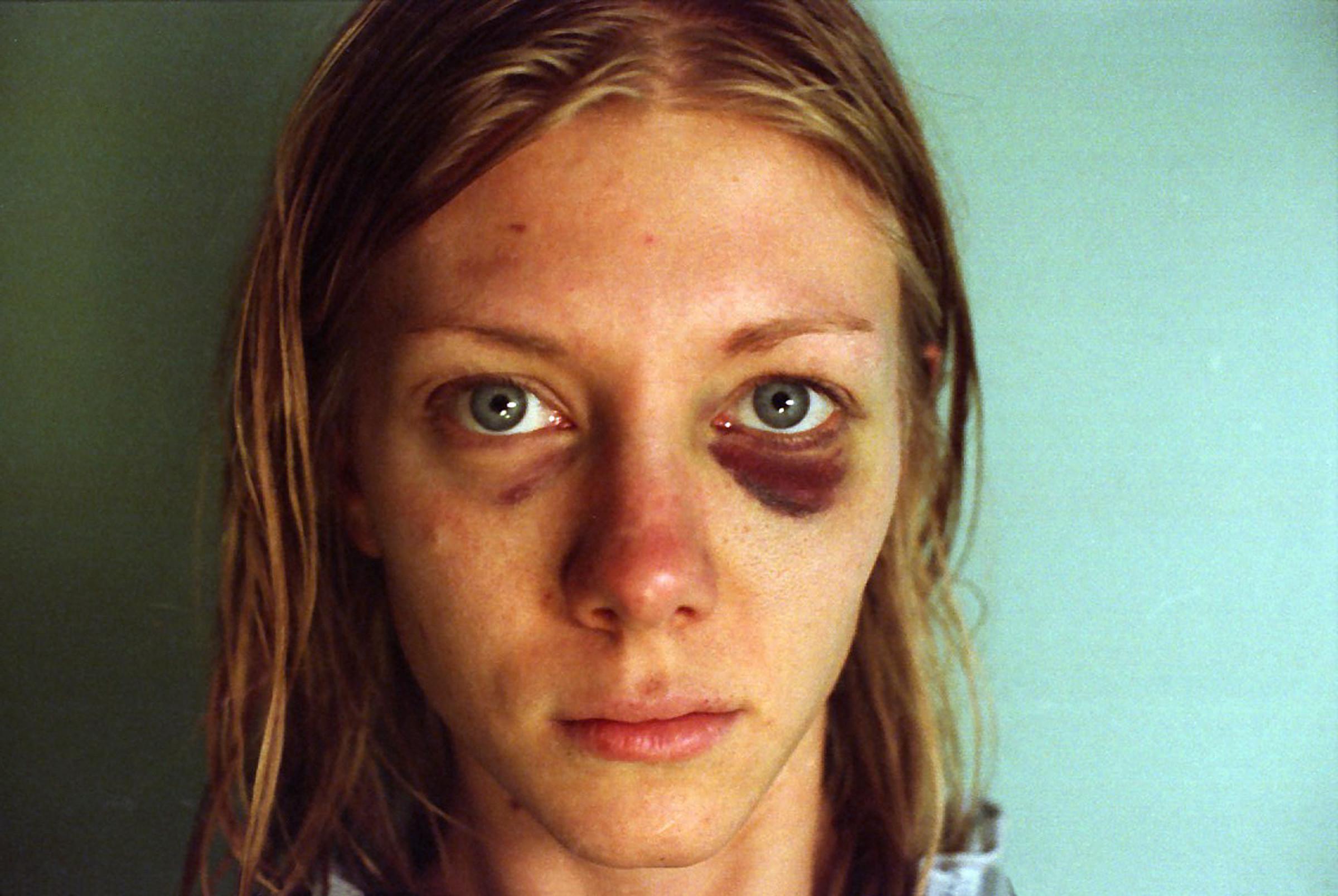 A light-skinned person with stringy blond hair, gray eyes, and a prominently bruised left eye stares directly at the viewer.